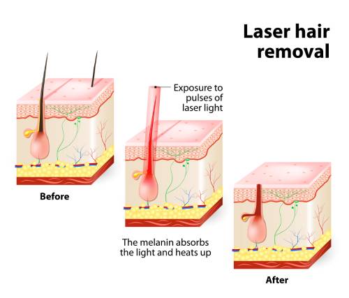 Κέντρο Laser & Αποτρίχωσης